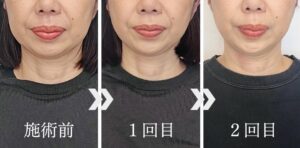 小顔矯正＆肩首矯正の変化 - 美容整体Regrage（リグラージュ）/ 若返り小顔矯正＆姿勢改善・たるみ、歪み、ほうれい線、二重あご、スマホ首、肩こり、首こりでのお悩みを根本改善