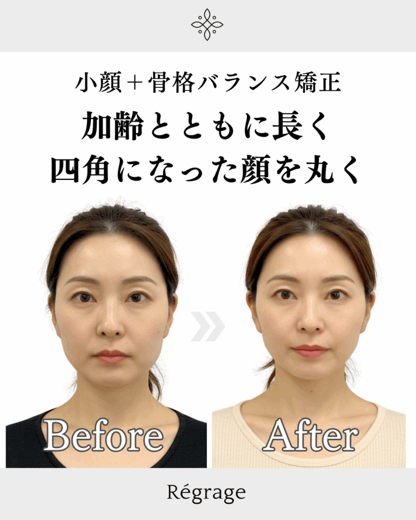 40代女性・加齢で長く四角になった顔を丸く/ 福岡博多の小顔矯正＆姿勢改善 - 美容整体Regrage（リグラージュ）