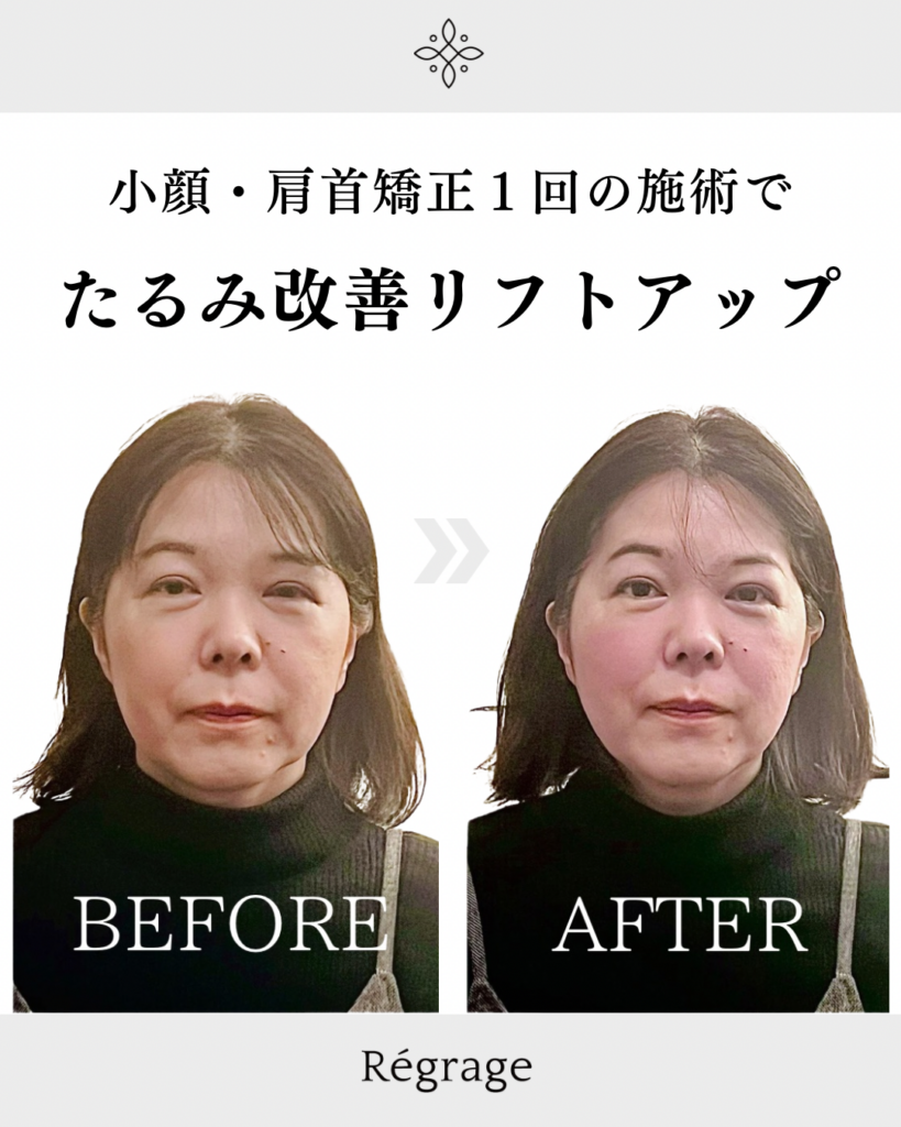 顔全体たるみとフェイスラインでお悩みでしたが、全体的に引き締まり目もぱっちりです。