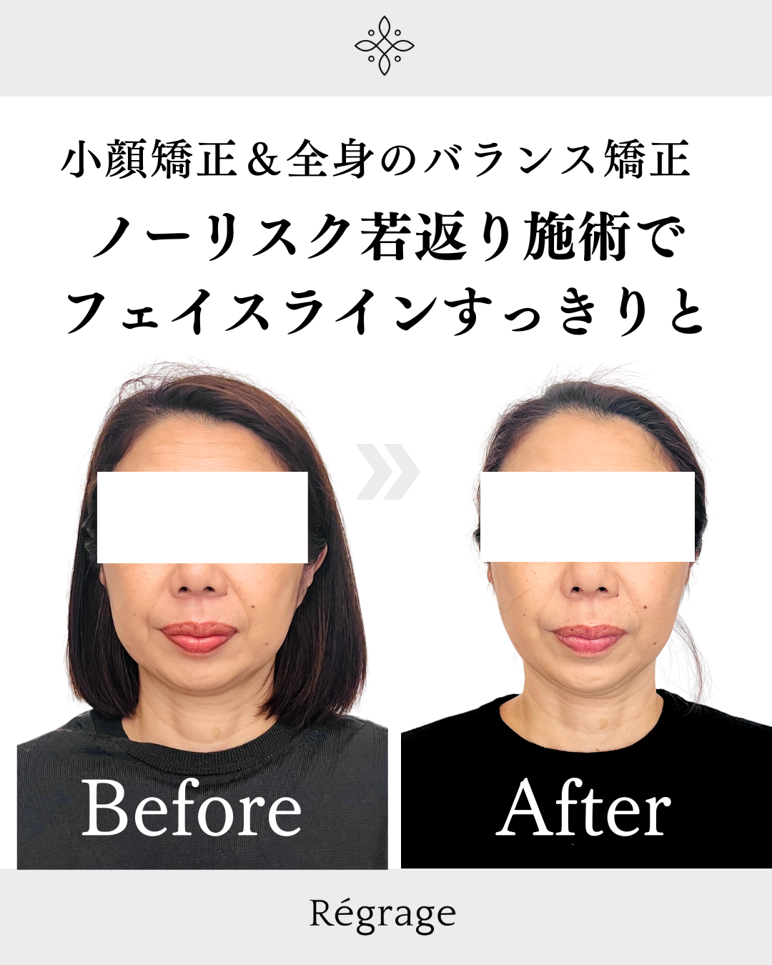 ノーリスク若返り施術でフェイスラインすっきりと - 美容整体Regrage（リグラージュ）/ 若返り小顔矯正＆姿勢改善・たるみ、歪み、ほうれい線、二重あご、スマホ首、肩こり、首こりでのお悩みを根本改善