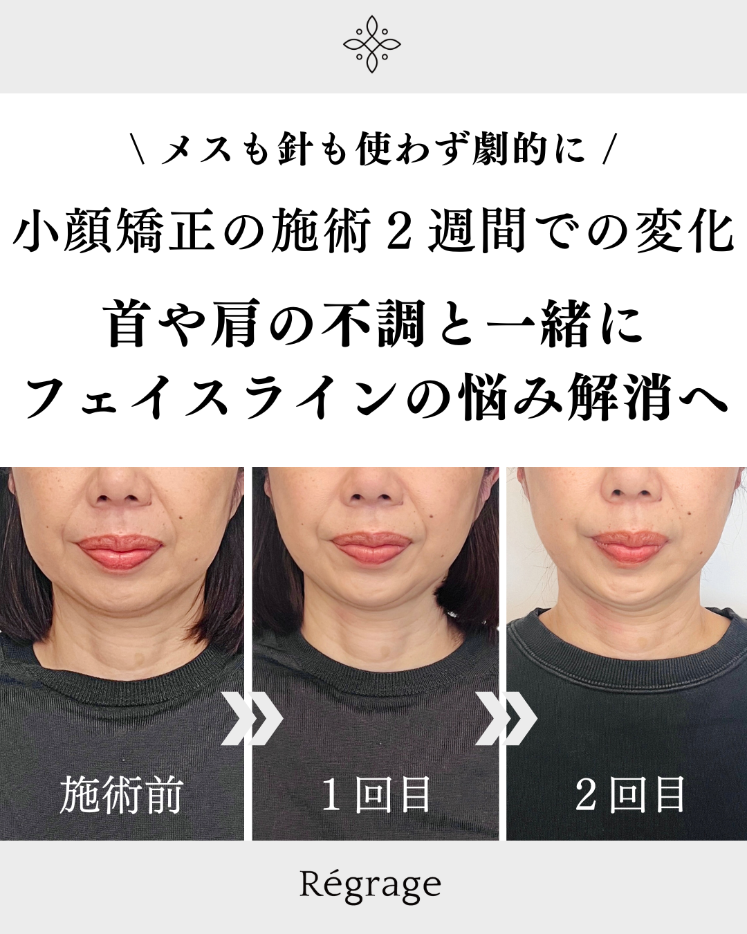 肩首の不調とフェイスラインの悩み解消へ - 美容整体Regrage（リグラージュ）/ 若返り小顔矯正＆姿勢改善・たるみ、歪み、ほうれい線、二重あご、スマホ首、肩こり、首こりでのお悩みを根本改善
