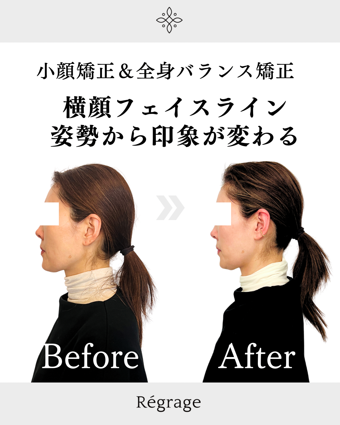 横顔フェイスライン姿勢から印象変わる - 美容整体Regrage（リグラージュ）/ 若返り小顔矯正＆姿勢改善・たるみ、歪み、ほうれい線、二重あご、スマホ首、肩こり、首こりでのお悩みを根本改善
