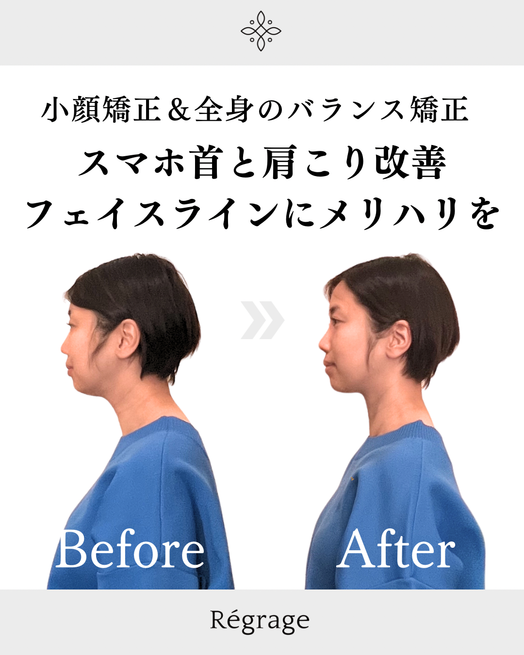 スマホ首と肩こり改善フェイスラインにメリハリを - 美容整体Regrage（リグラージュ）/ 若返り小顔矯正＆姿勢改善・たるみ、歪み、ほうれい線、二重あご、スマホ首、肩こり、首こりでのお悩みを根本改善