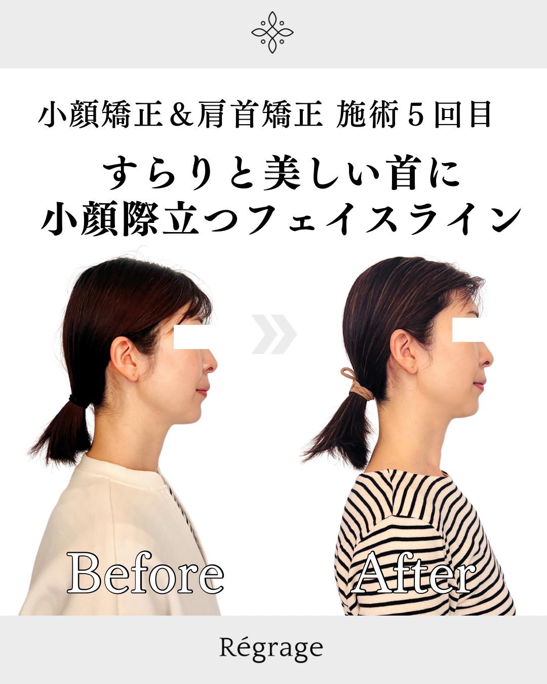 すらりと美しいネックラインと小顔際立つフェイスラインへ - 美容整体Regrage（リグラージュ）/ 若返り小顔矯正＆姿勢改善・たるみ、歪み、ほうれい線、二重あご、スマホ首、肩こり、首こりでのお悩みを根本改善