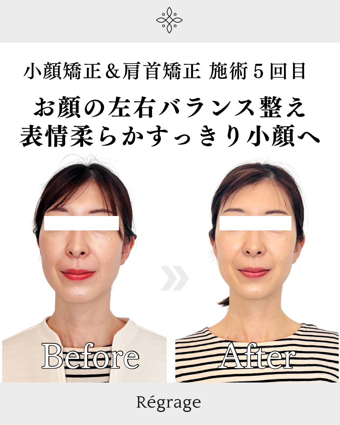 顔の左右差整え表情柔らかすっきり小顔へ - 美容整体Regrage（リグラージュ）/ 若返り小顔矯正＆姿勢改善・たるみ、歪み、ほうれい線、二重あご、スマホ首、肩こり、首こりでのお悩みを根本改善