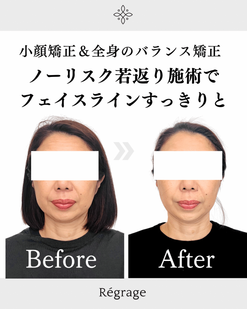 ノーリスク若返り施術でフェイスラインすっきりと - 美容整体Regrage(リグラージュ)/ 若返り小顔矯正&姿勢改善・たるみ、歪み、ほうれい線、二重あご、スマホ首、肩こり、首こりでのお悩みを根本改善