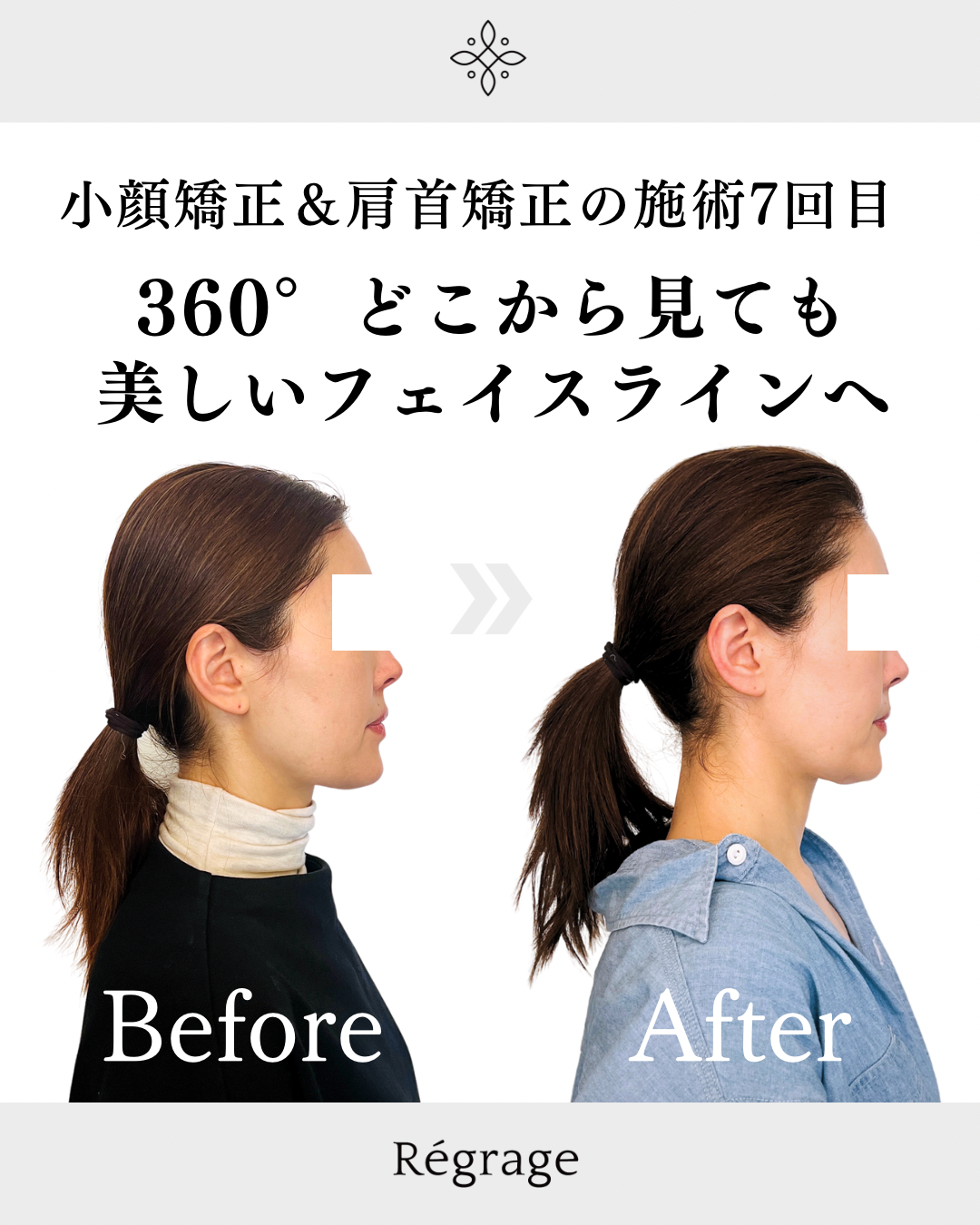 360°どこから見ても美しいフェイスラインへ - 美容整体Regrage（リグラージュ）/ 若返り小顔矯正＆姿勢改善・たるみ、歪み、ほうれい線、二重あご、スマホ首、肩こり、首こりでのお悩みを根本改善