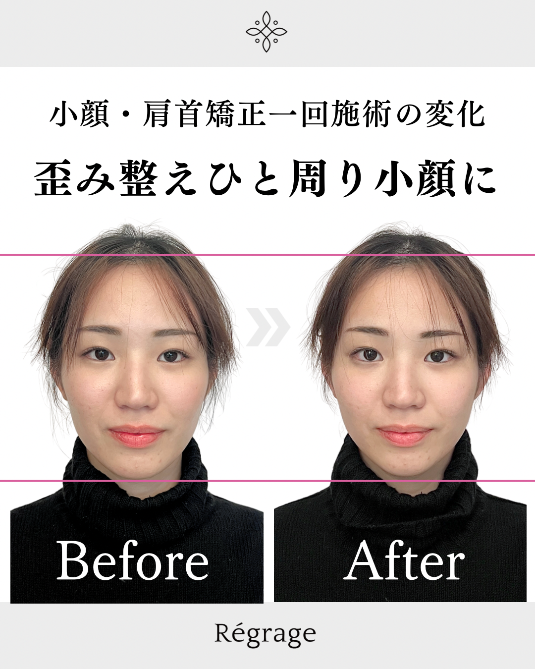 歪み整えひと回り小顔に - 美容整体Regrage（リグラージュ）/ 若返り小顔矯正＆姿勢改善・たるみ、歪み、ほうれい線、二重あご、スマホ首、肩こり、首こりでのお悩みを根本改善