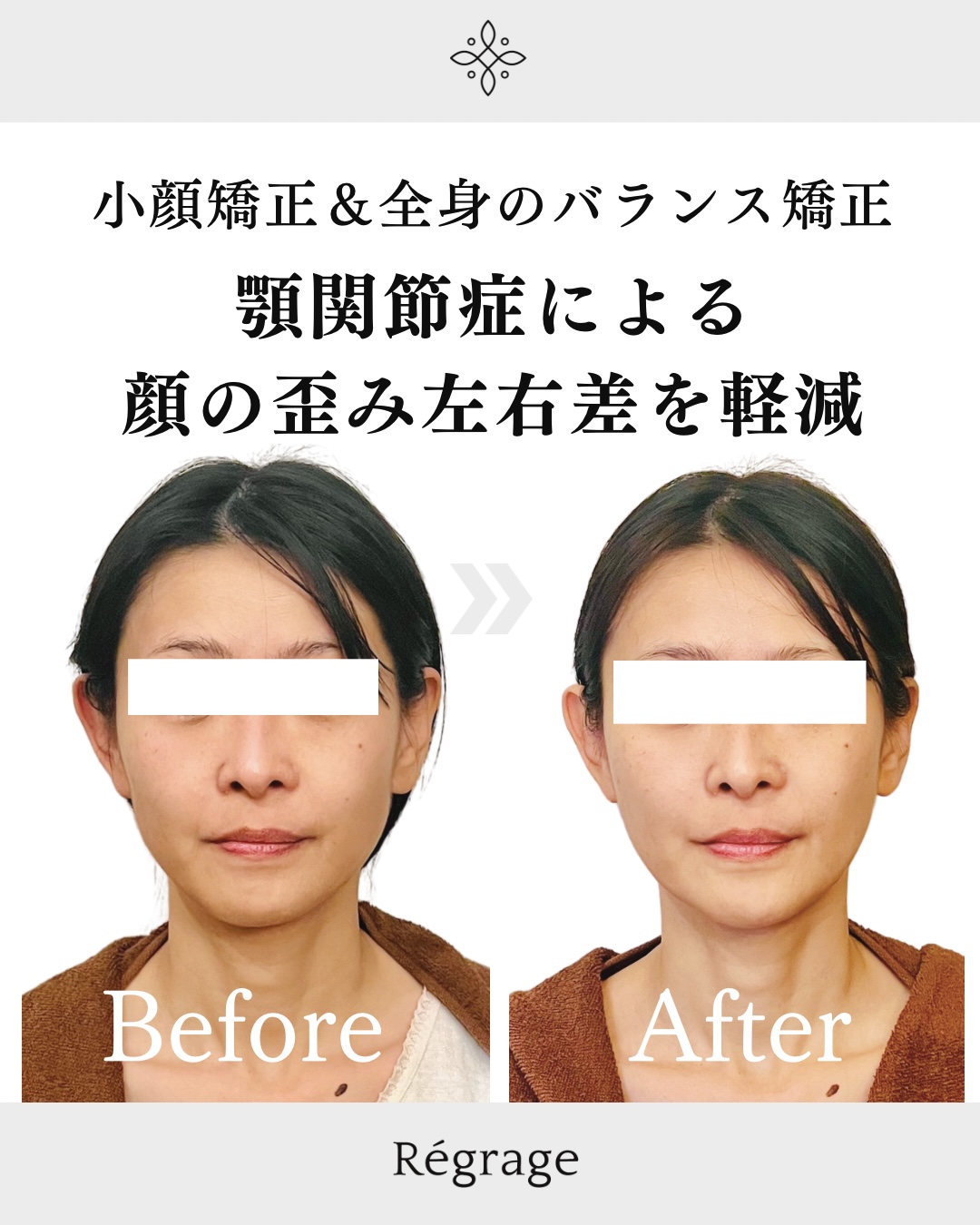 顎関節症による顔の歪み左右差を軽減 - 美容整体Regrage（リグラージュ）/ 若返り小顔矯正＆姿勢改善・たるみ、歪み、ほうれい線、二重あご、スマホ首、肩こり、首こりでのお悩みを根本改善