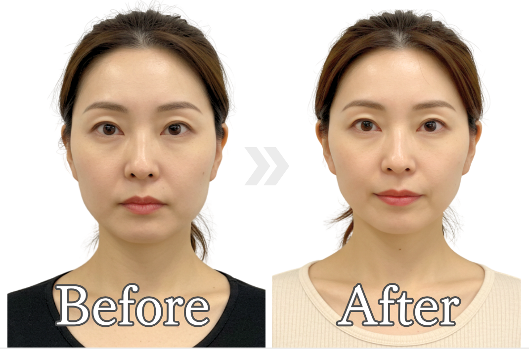 40代女性・加齢で長く四角になった顔を丸く/ 福岡博多の小顔矯正&姿勢改善 - 美容整体Regrage(リグラージュ)