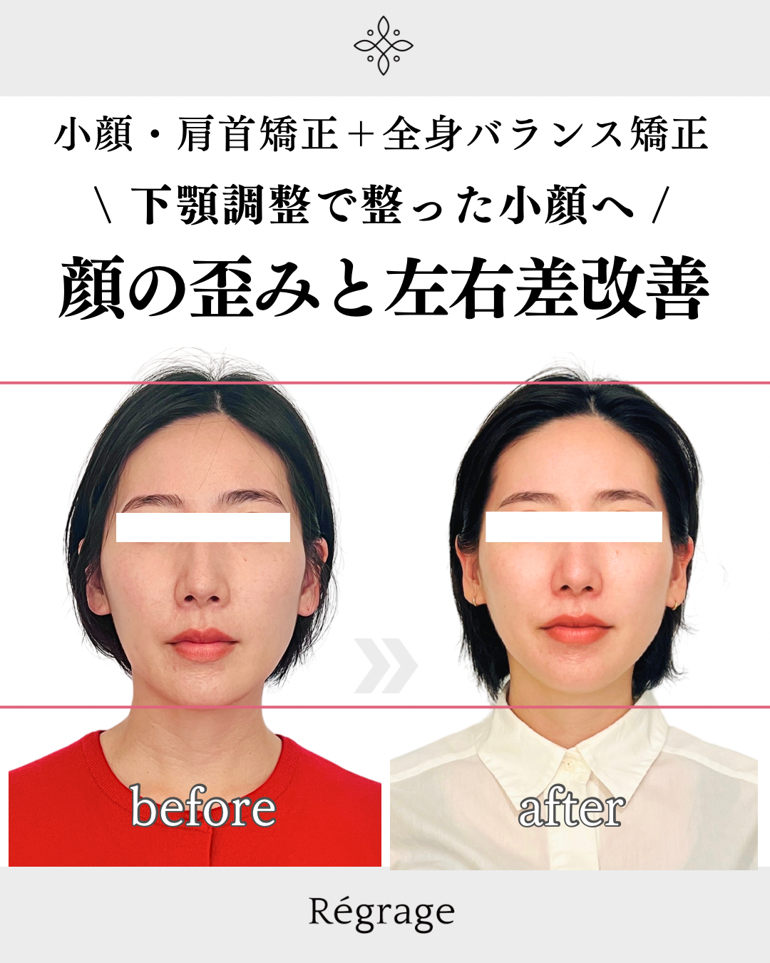 30代女性・アゴの歪みと顔の左右差を骨格矯正で改善/ 福岡博多の小顔矯正＆姿勢改善 - 美容整体Regrage（リグラージュ）