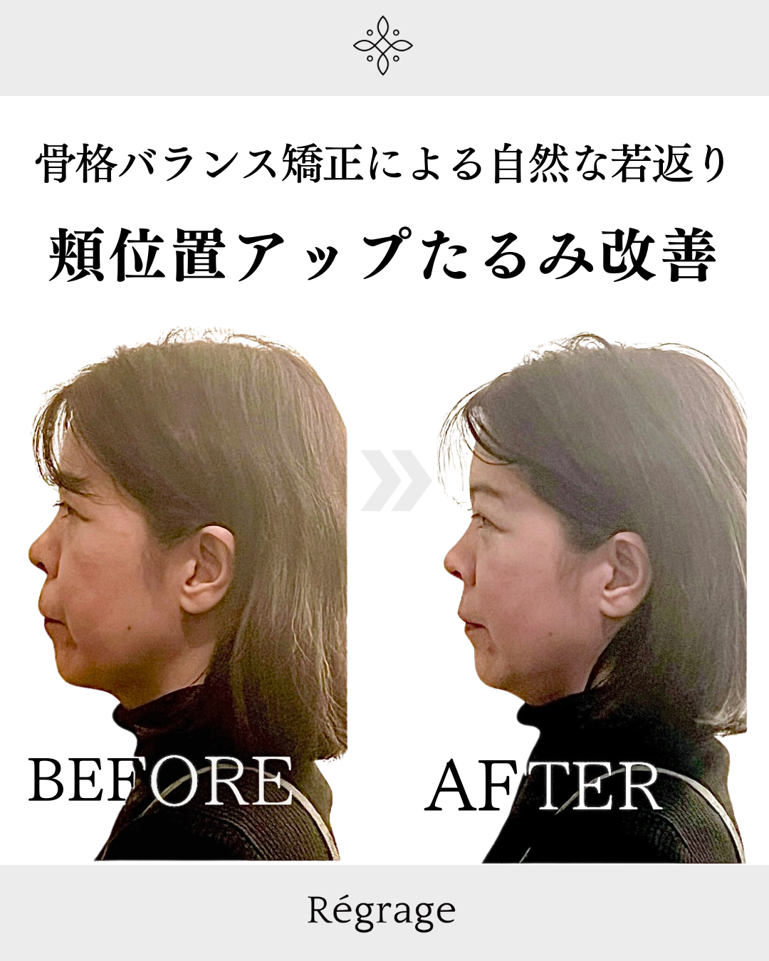 50代女性・顔全体たるみとフェイスライン引き締め / 福岡博多の小顔矯正＆姿勢改善 - 美容整体Regrage（リグラージュ）