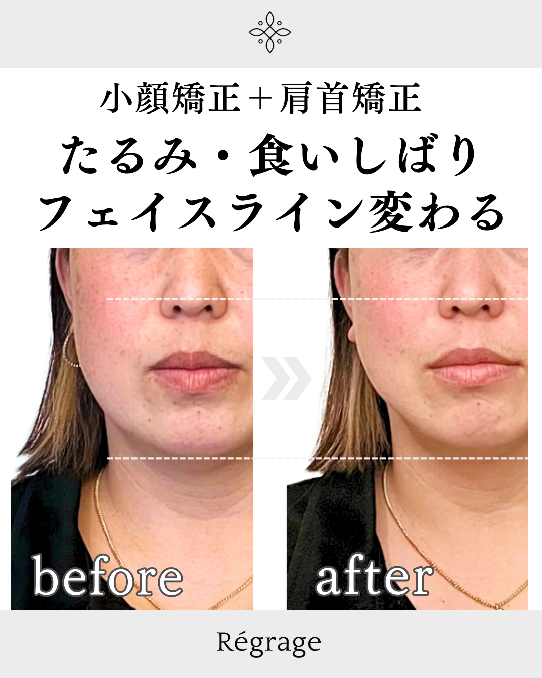 40代女性・たるみ、食いしばり骨格矯正で改善/ 福岡博多の小顔矯正＆姿勢改善 - 美容整体Regrage（リグラージュ）