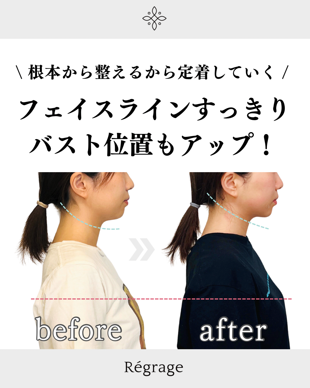 顔の左右差・食いしばり