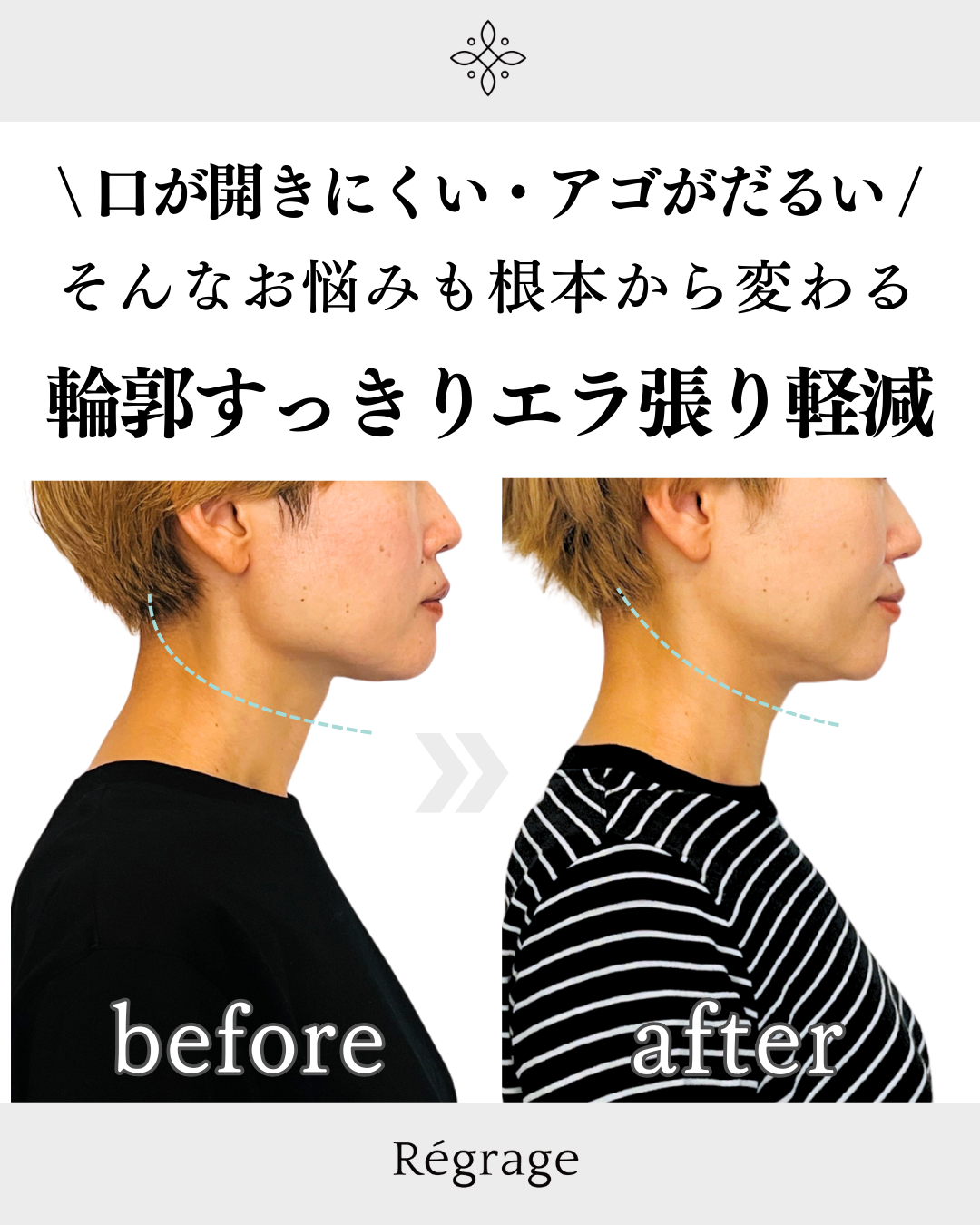 40代女性エラ張り・食いしばり