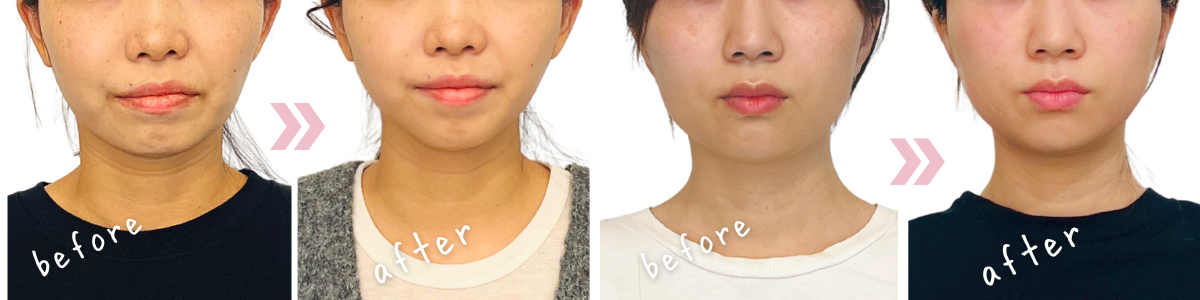 顔の左右差・むくみ・輪郭の悩み - お客さまのビフォーアフター / 福岡の美容整体リグラージュ