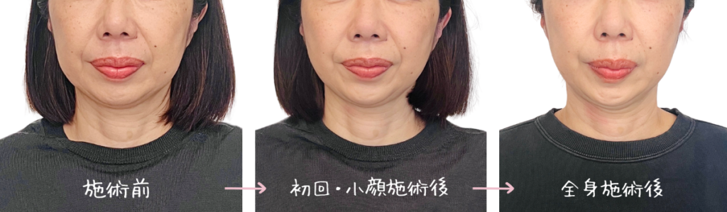 リグラージュの施術前 / 初回の小顔+肩首矯正施術後 / 二回目の骨格バランス矯正施術後