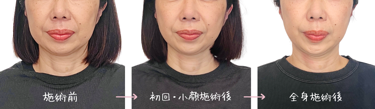 リグラージュの施術前 / 初回の小顔+肩首矯正施術後 / 二回目の骨格バランス矯正施術後
