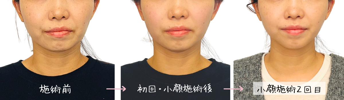 顔の左右差・むくみ・輪郭の悩み - お客さまのビフォーアフター / 福岡の小顔矯正専門：美容整体リグラージュ