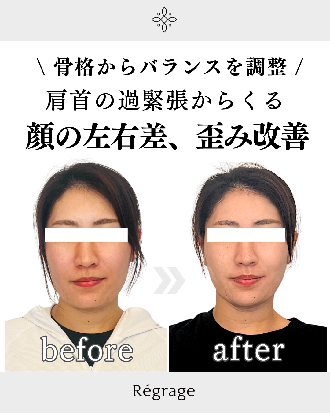 30代女性・顔の歪み（左右差）改善/ 福岡博多の小顔矯正＆姿勢改善 - 美容整体Regrage（リグラージュ）