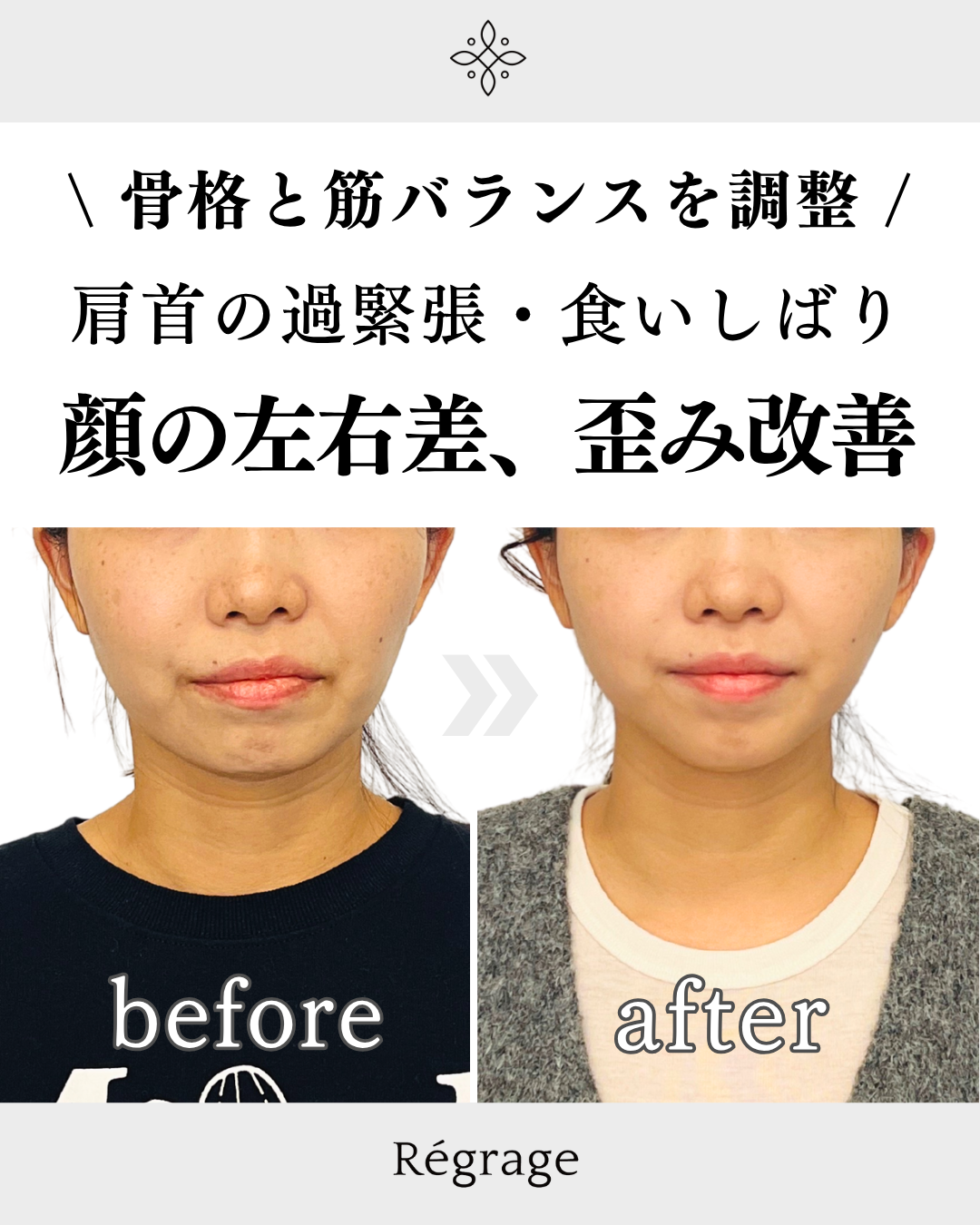30代女性・顔の歪み（左右差）食いしばり改善/ 福岡博多の小顔矯正＆姿勢改善 - 美容整体Regrage（リグラージュ）