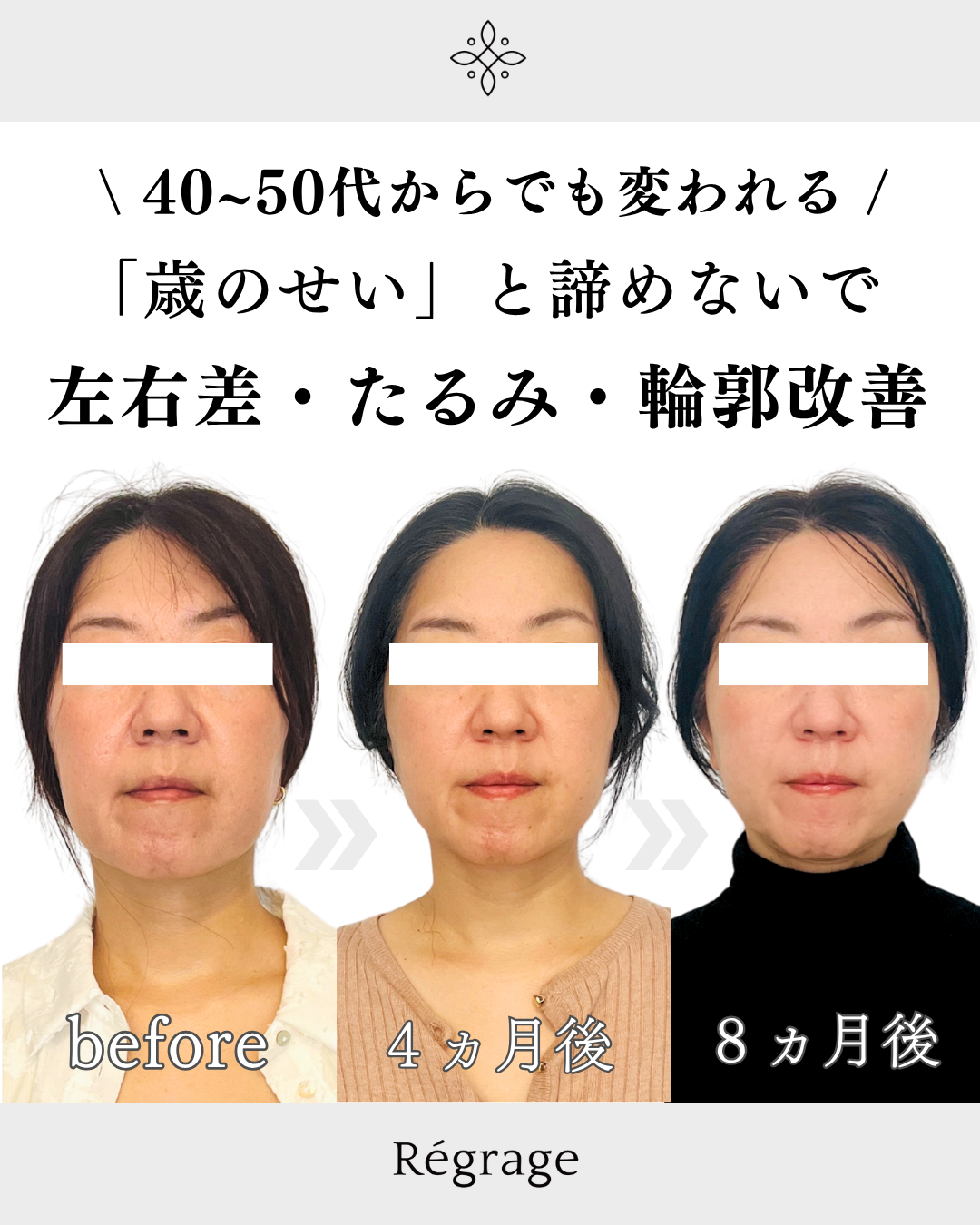40代女性・顔全体たるみとフェイスライン引き締め / 福岡博多の小顔矯正＆姿勢改善 - 美容整体Regrage（リグラージュ）