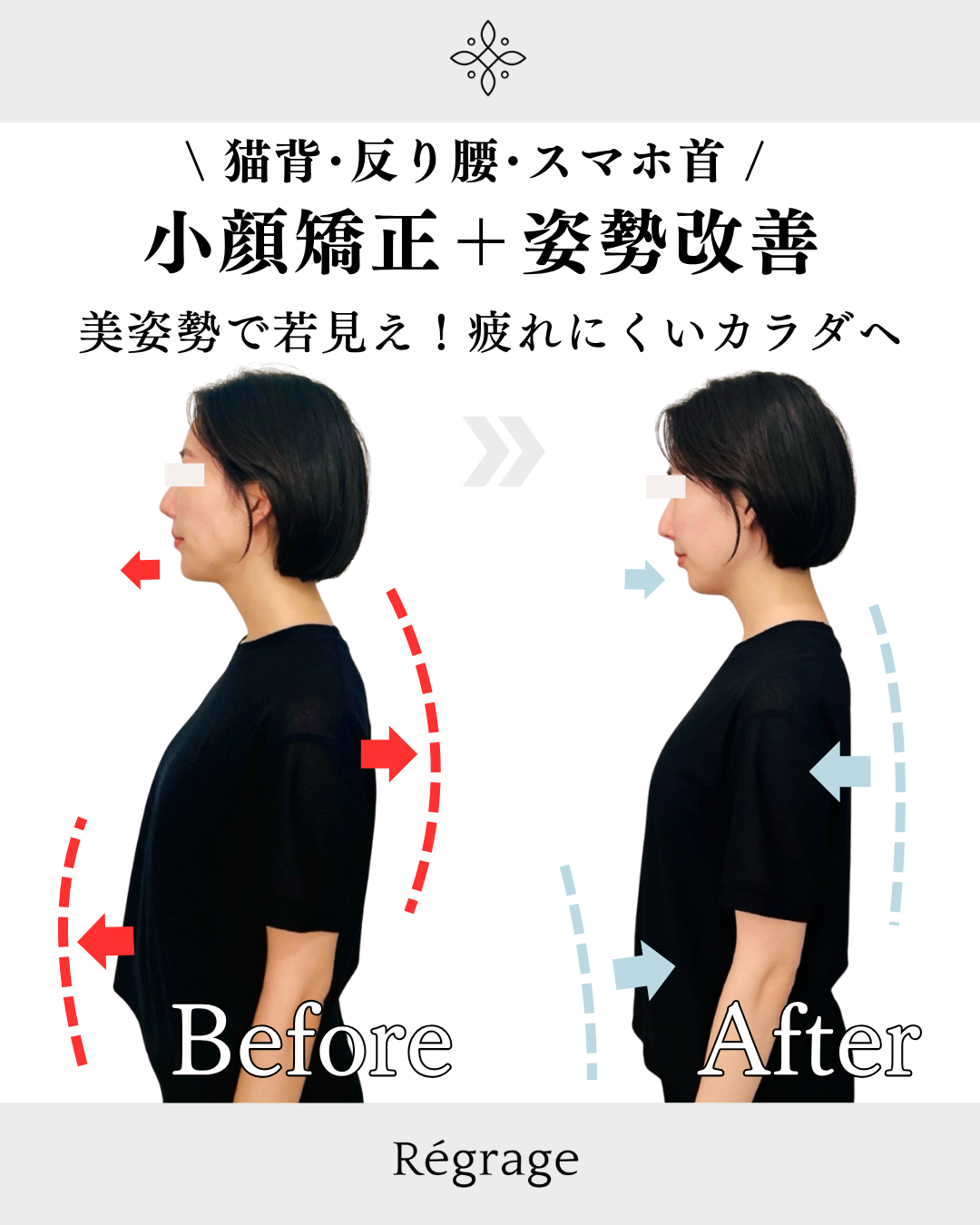 30代女性・アゴの歪みと顔の左右差を骨格矯正で改善/ 福岡博多の小顔矯正＆姿勢改善 - 美容整体Regrage（リグラージュ）