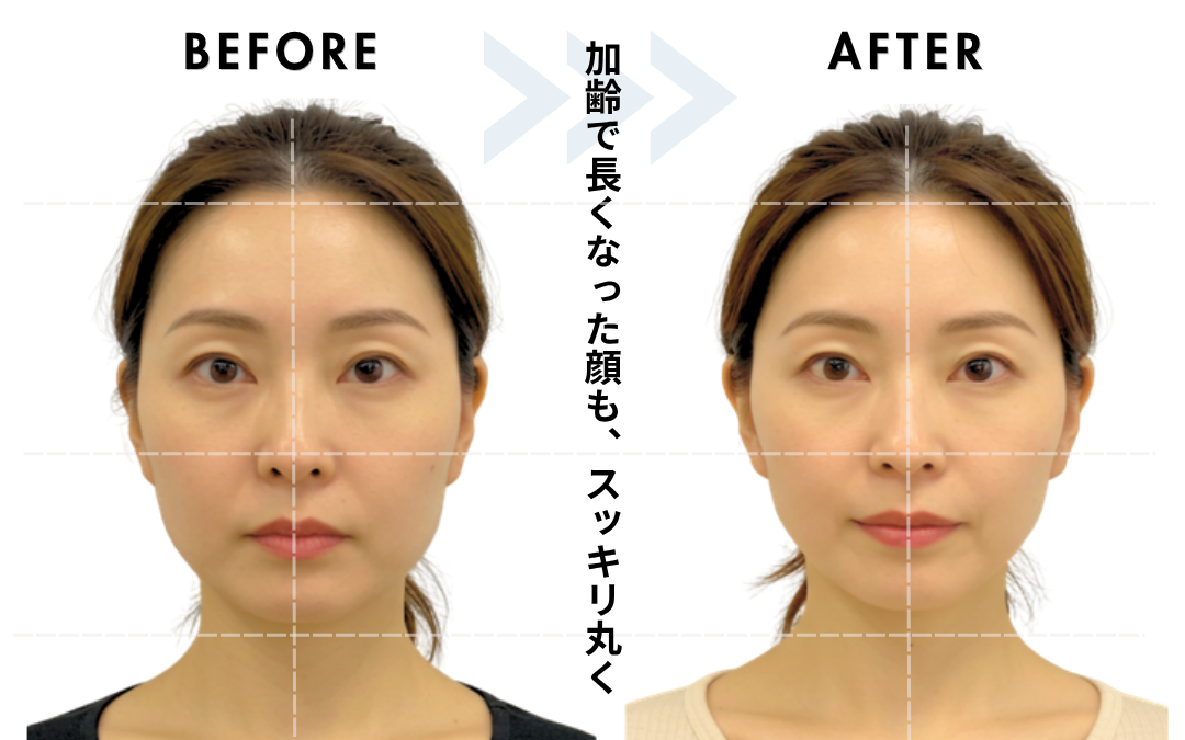 40代女性、施術5回の変化（※効果には個人差があります）