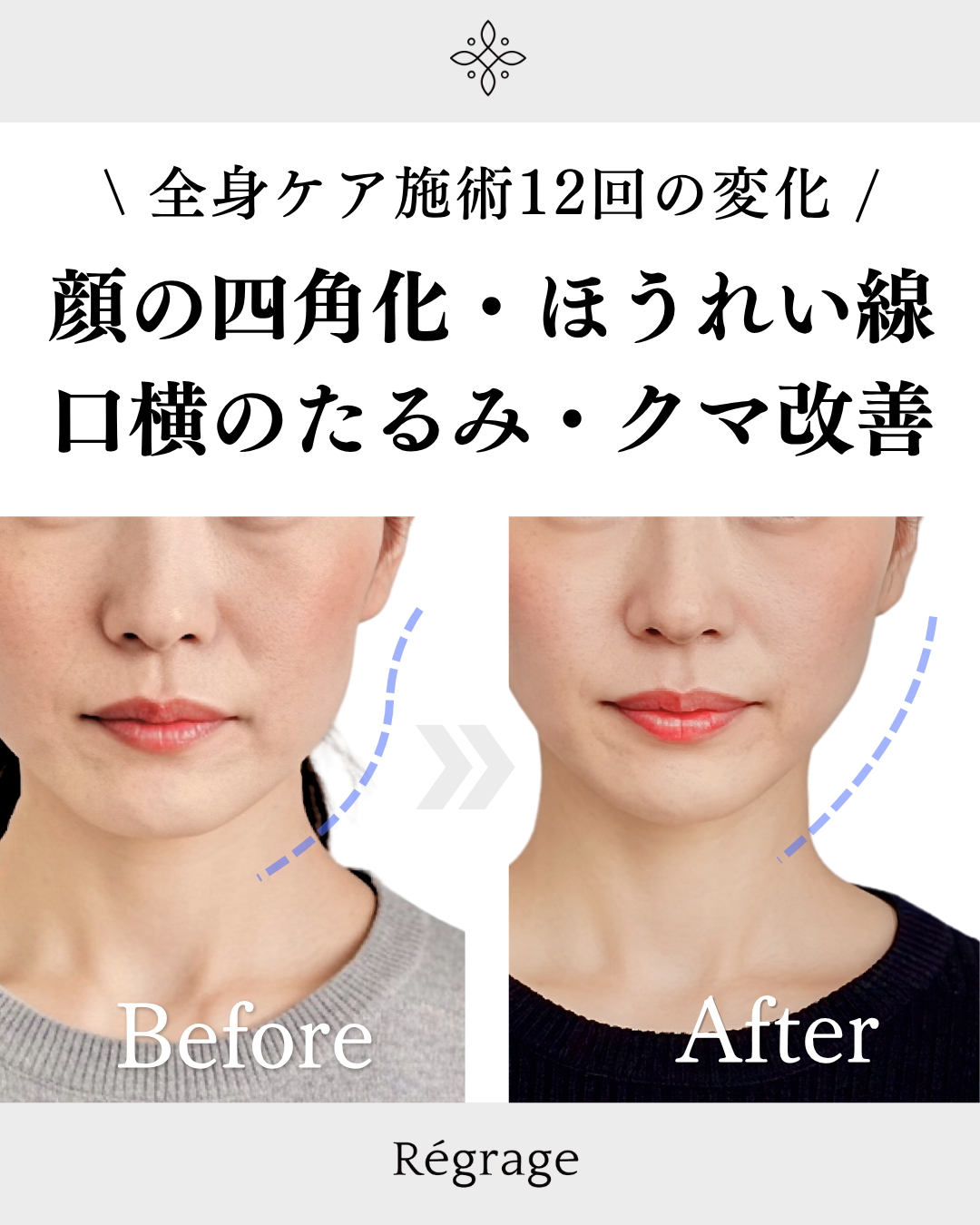 顔の四角化・たるみ・ほうれい線・クマ改善 - 美容整体リグラージュ