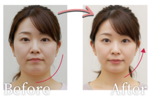 30代女性・全身ケア12回の変化(※効果には個人差があります)